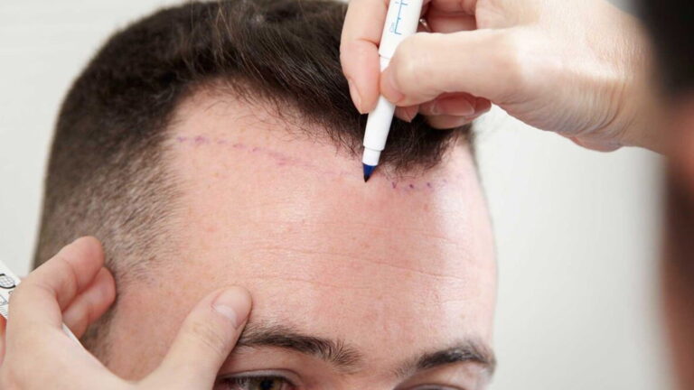 Live Hair Clinic: İstanbul Saç Ekimi Alanında Güvenin ve Kalitenin Adı