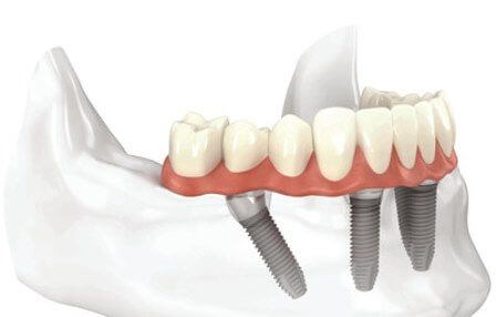 Şeffaf Plak Fiyatları 2026: Invisalign ve Alternatiflerin Maliyet Karşılaştırması