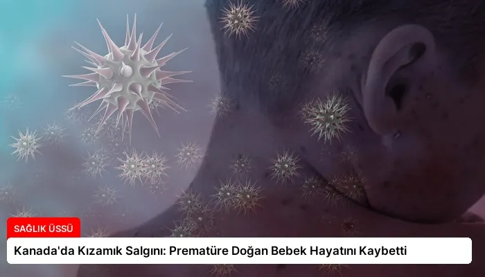 Kanada’da Kızamık Salgını: Prematüre Doğan Bebek Hayatını Kaybetti