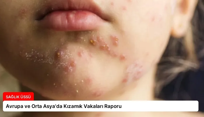 Avrupa ve Orta Asya’da Kızamık Vakaları Raporu