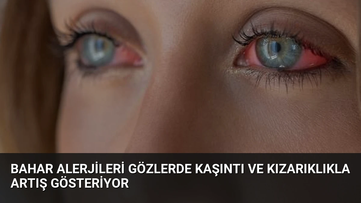 Bahar Alerjileri Gözlerde Kaşıntı ve Kızarıklıkla Artış Gösteriyor