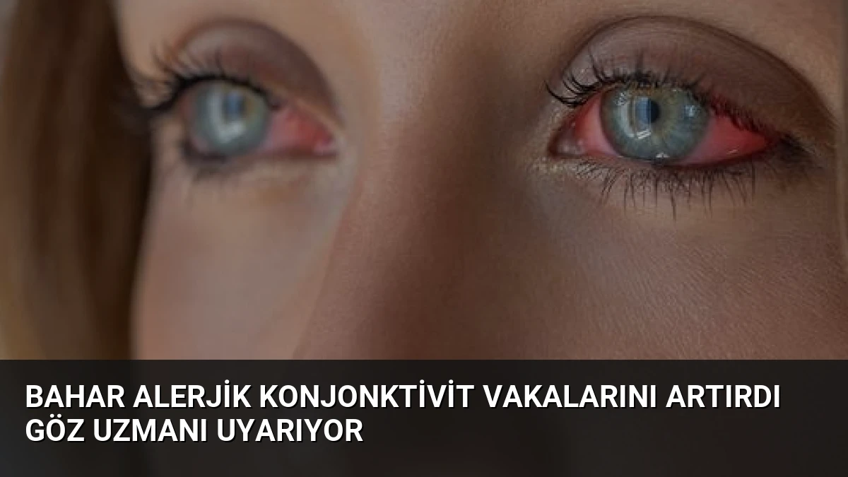 Bahar Alerjik Konjonktivit Vakalarını Artırdı Göz Uzmanı Uyarıyor