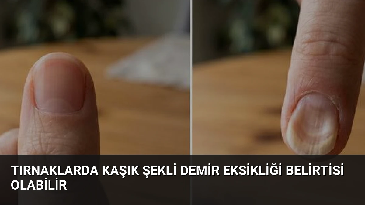 Tırnaklarda Kaşık Şekli Demir Eksikliği Belirtisi Olabilir