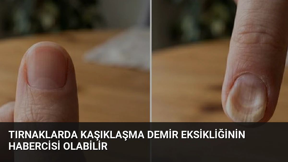 Tırnaklarda Kaşıklaşma Demir Eksikliğinin Habercisi Olabilir