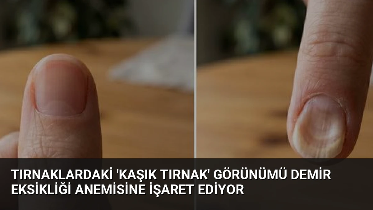 Tırnaklardaki ‘Kaşık Tırnak’ Görünümü Demir Eksikliği Anemisine İşaret Ediyor