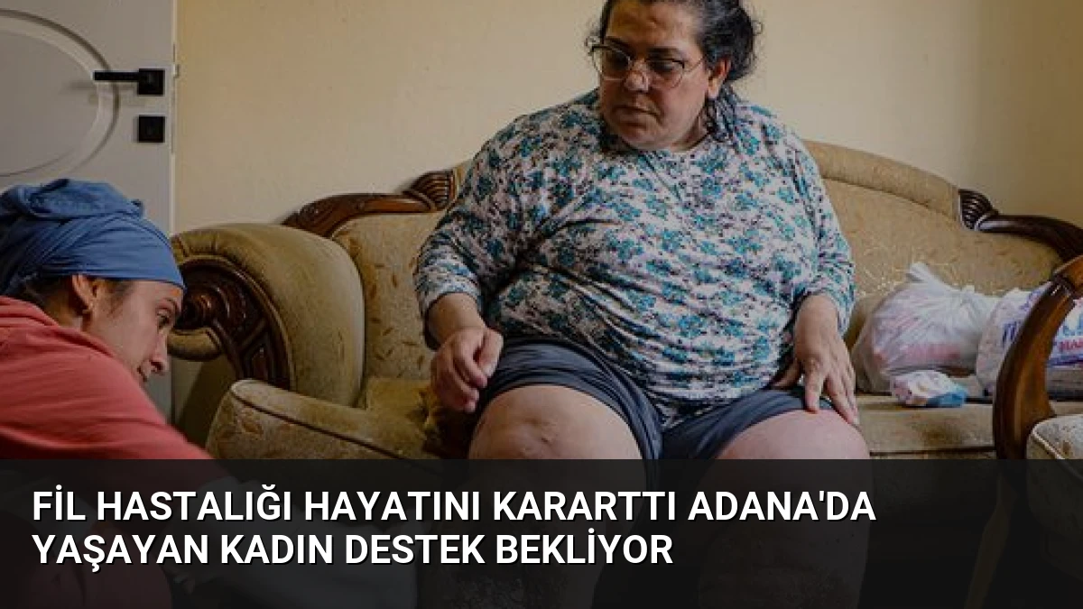 Fil Hastalığı Hayatını Kararttı Adana’da Yaşayan Kadın Destek Bekliyor