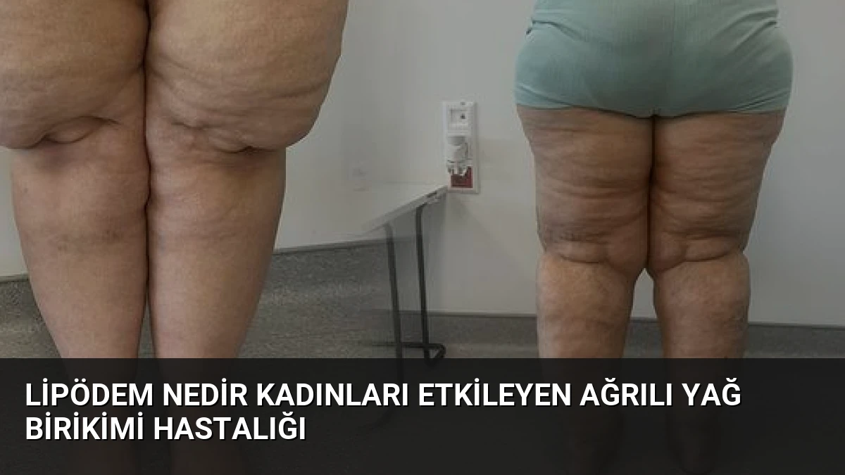 Lipödem Nedir Kadınları Etkileyen Ağrılı Yağ Birikimi Hastalığı