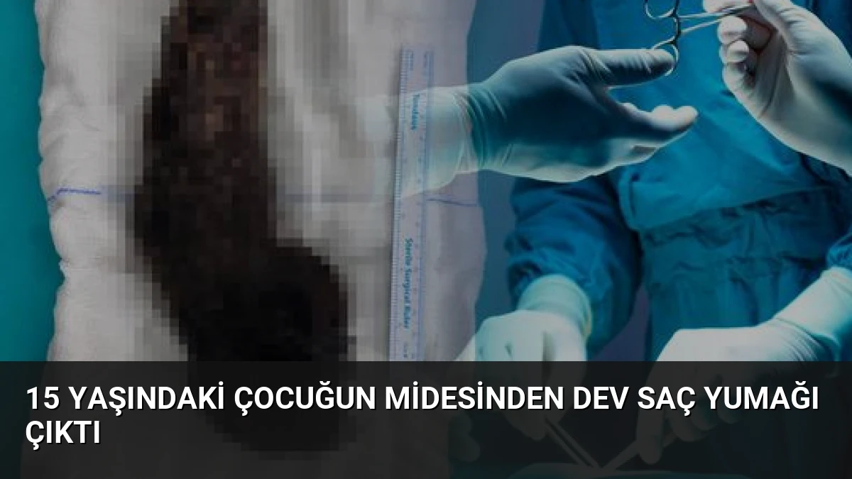 15 Yaşındaki Çocuğun Midesinden Dev Saç Yumağı Çıktı