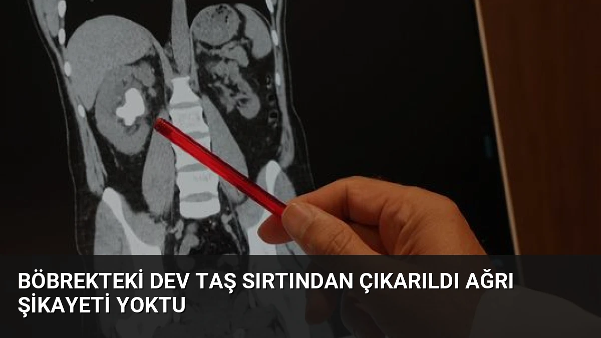 Böbrekteki Dev Taş Sırtından Çıkarıldı Ağrı Şikayeti Yoktu