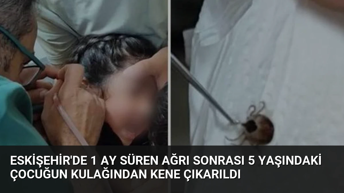 Eskişehir’de 1 Ay Süren Ağrı Sonrası 5 Yaşındaki Çocuğun Kulağından Kene Çıkarıldı