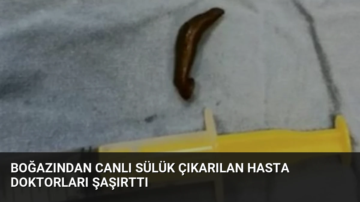 Boğazından Canlı Sülük Çıkarılan Hasta Doktorları Şaşırttı