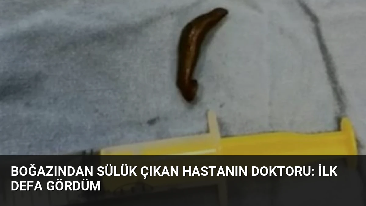 Boğazından Sülük Çıkan Hastanın Doktoru: İlk Defa Gördüm