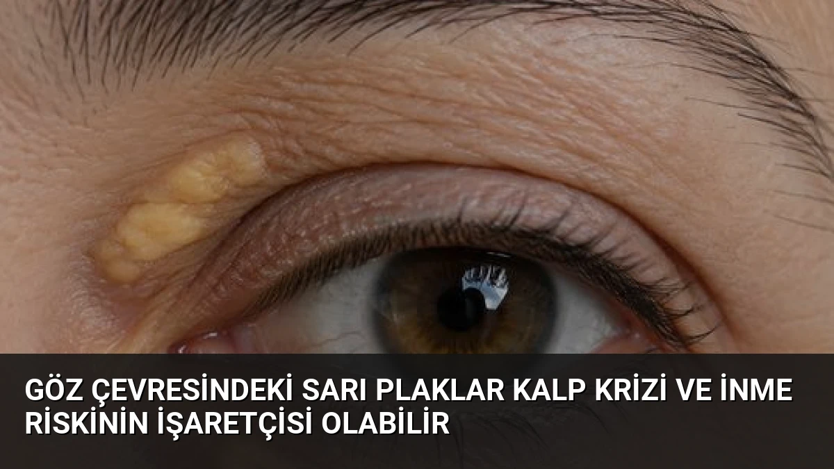 Göz Çevresindeki Sarı Plaklar Kalp Krizi ve İnme Riskinin İşaretçisi Olabilir
