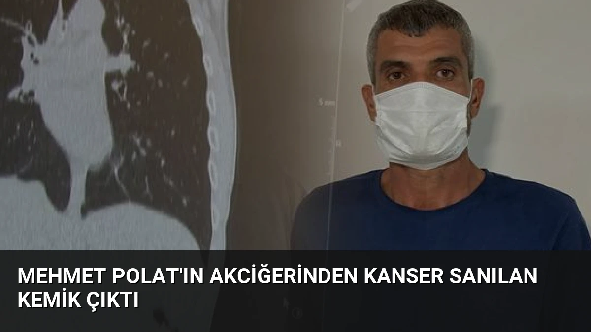 Mehmet Polat’ın Akciğerinden Kanser Sanılan Kemik Çıktı