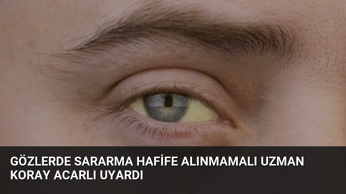 Gözlerde Sararma Hafife Alınmamalı Uzman Koray Acarlı Uyardı