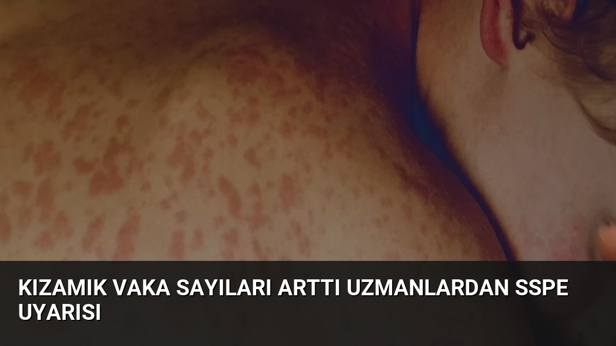 Kızamık Vaka Sayıları Arttı Uzmanlardan SSPE Uyarısı